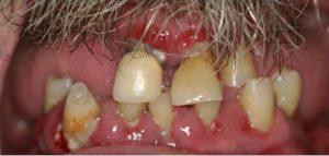 Hybrid Denture Treatment in Texas