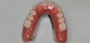 Snap on Denture Lower Treatment and Fix in Carrollton,Texas