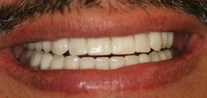 snap lock dentures in Carrollton,Texas