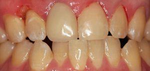 gum disease,Denture and Implants Texas