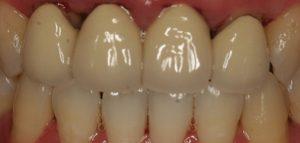 gum disease,Denture and Implants,Carrollton, Texas
