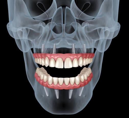 Dentures and Implants Carrollton Texas