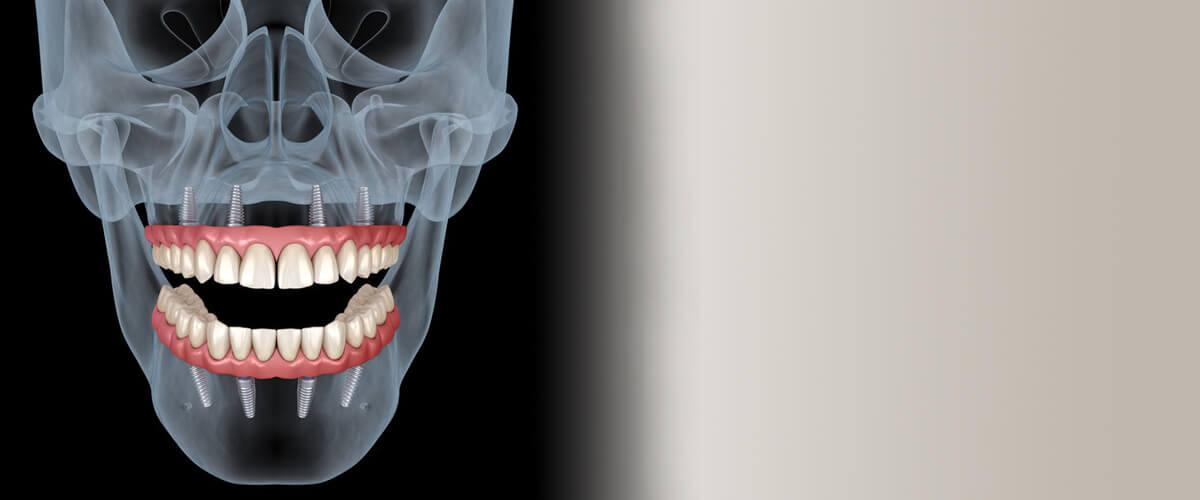 Dentures and Implants in Carrollton texas
