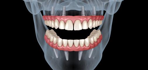 Full dentures treatment and fixing near Carrollton