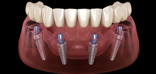 Immediate Dentures treatment in Carrollton