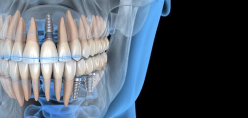 Immediate Dentures in Carrollton