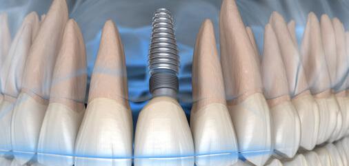 Mini Dental Implants fixing in Carrollton
