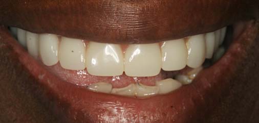 Full dentures in Carrollton