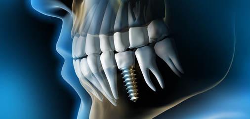 Single teeth denture replacement in Carrollton