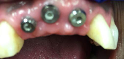 Multiple Teeth Replacements in Carrollton