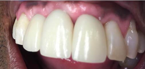 Multiple Teeth Replacements Carrollton